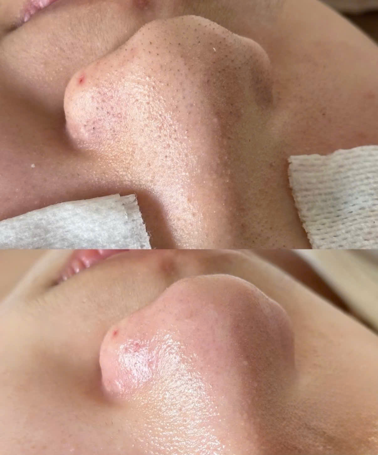 Kết quả chăm sóc da cằm sạch mụn