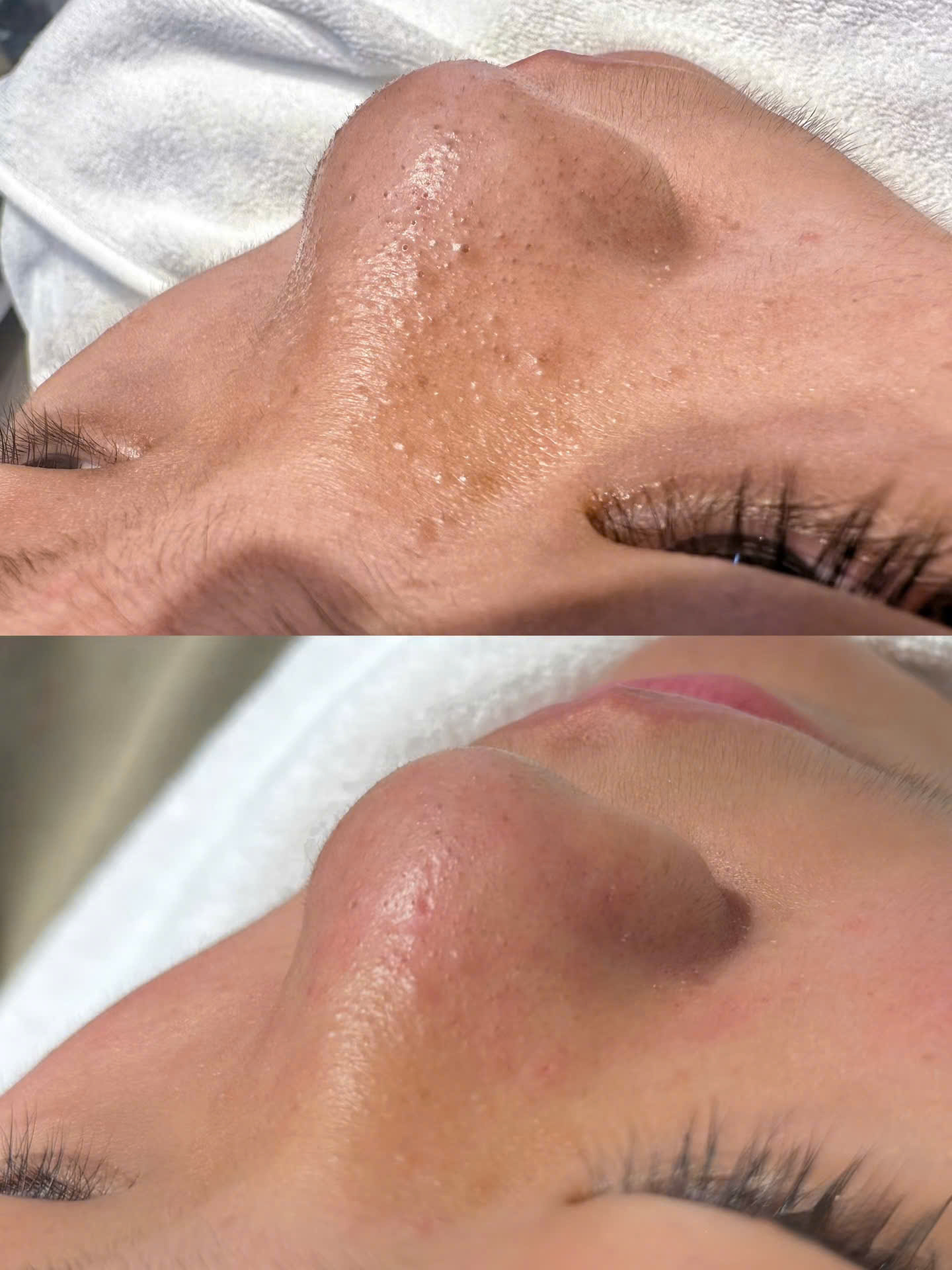 Trước và sau khi lấy nhân mụn ẩn vùng mũi
