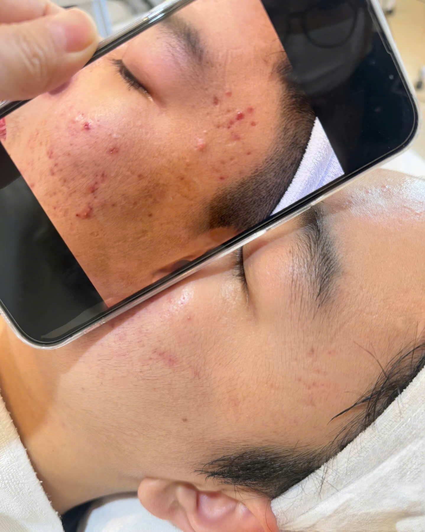 Trước và sau chăm sóc da mụn vùng cằm