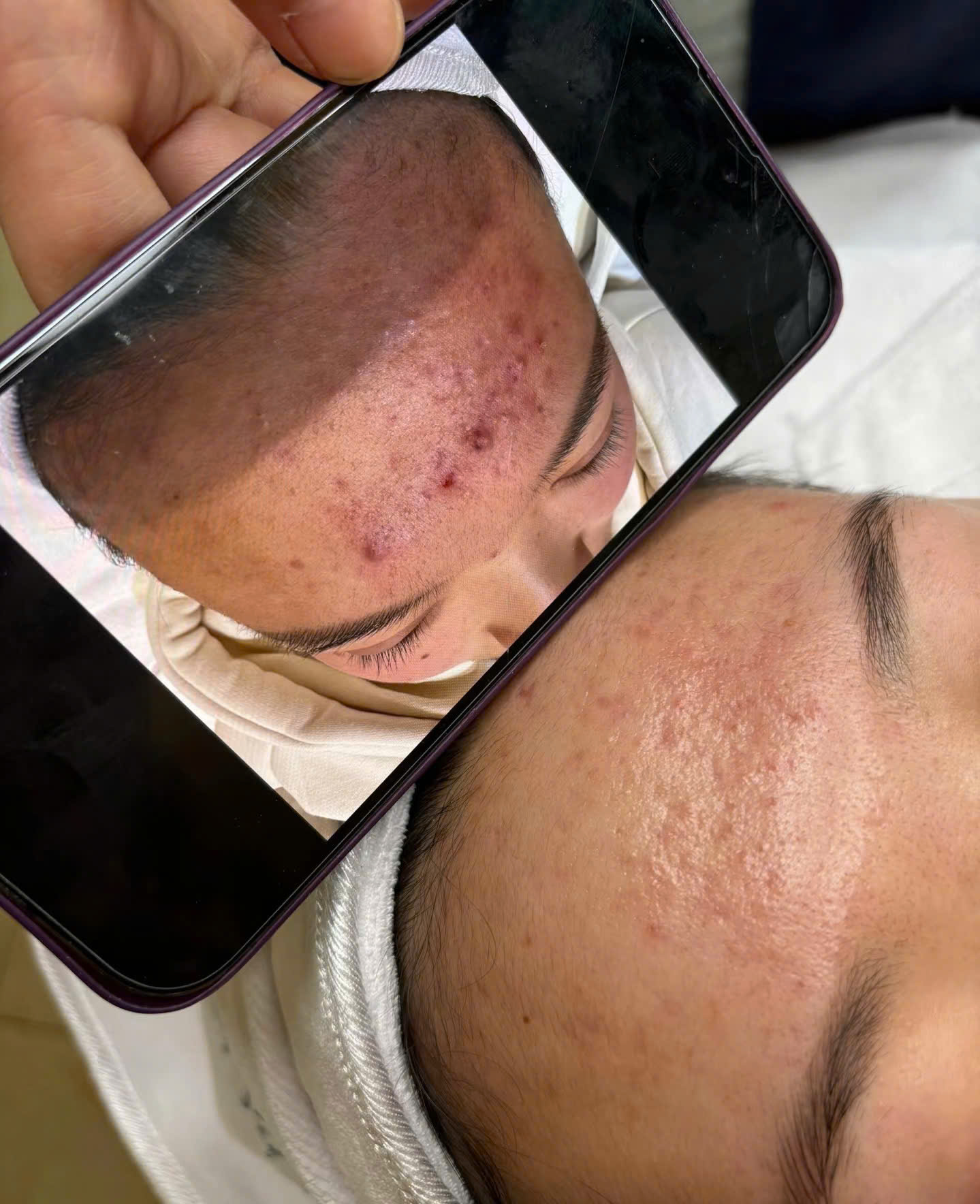 Trước và sau chăm sóc mụn vùng trán