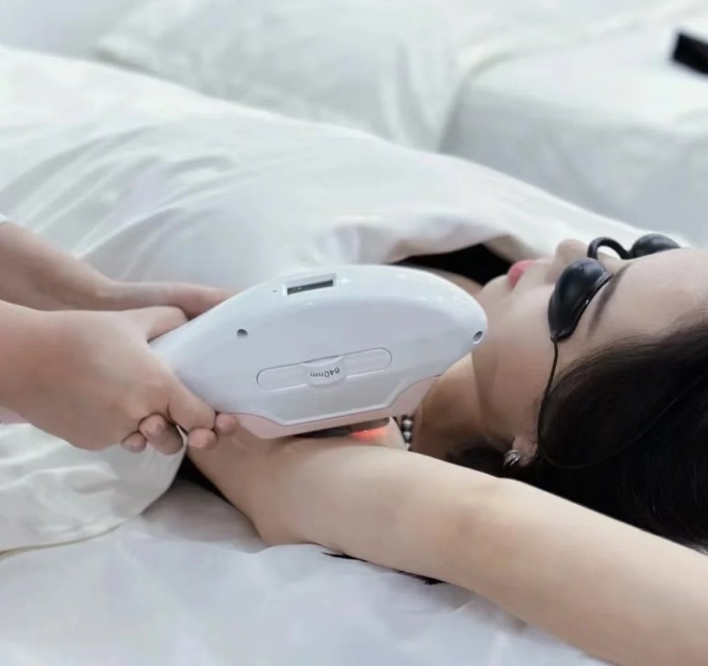 Triệt lông công nghệ IPL tại MÊ BEAUTY