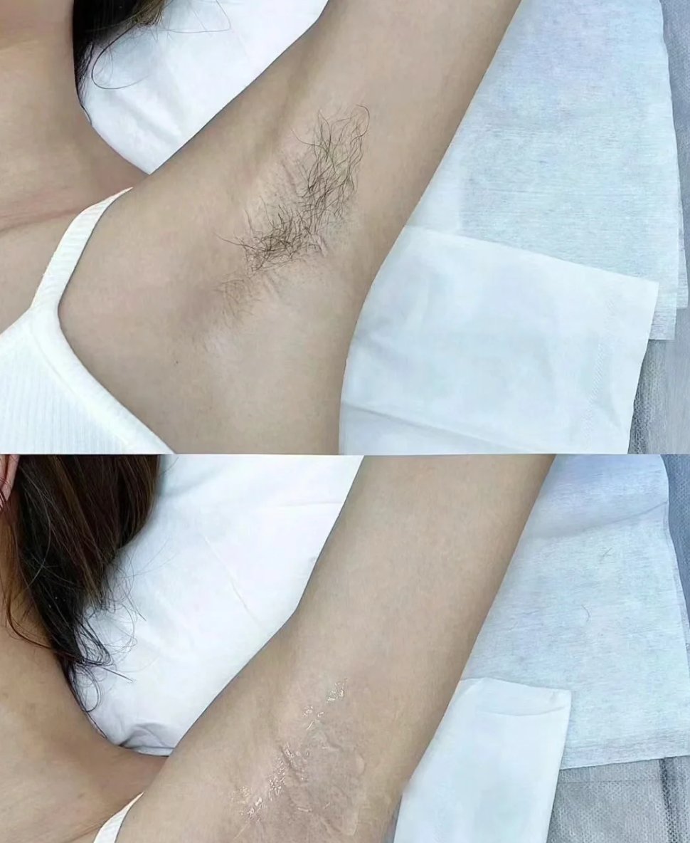 Before after triệt nách tại MÊ BEAUTY